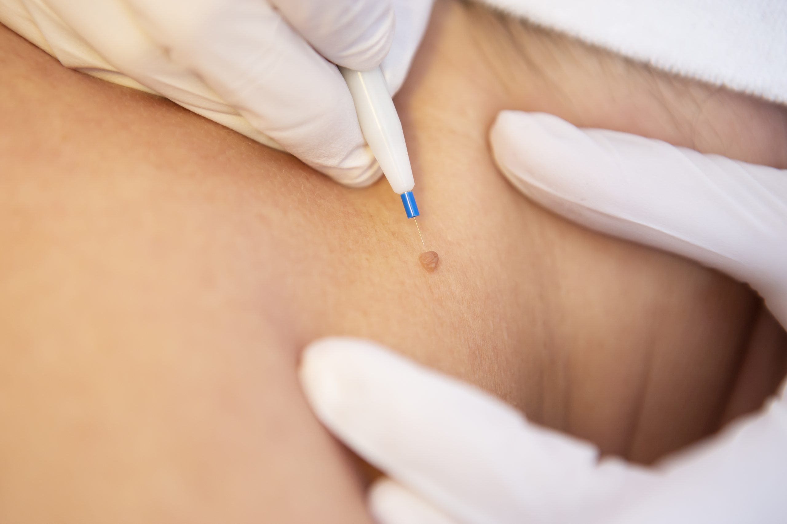 Fibromen Medisch Schoonheidsspecialiste Cosmetisch arts PH Formula Skin Resurfacing Permanente make up Cosmetisch arts Huidtherapie SkinFix Schoonheidssalon Schoonheidsspecialiste Volkel Uden Veghel Oss Erp Boekel Mill Nistelrode Vorstenbosch Fibromen