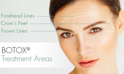 Botox SkinFix Schoonheidssalon Schoonheidsspecialiste Volkel Uden Veghel Oss Erp Boekel Mill Botox Volkel Uden