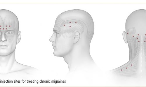 botox tegen migraine SkinFix Schoonheidssalon Schoonheidsspecialiste Volkel Uden Veghel Oss Erp Boekel Mill Botox tegen migraine in Volkel Uden