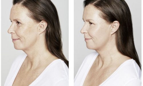 Fillers SkinFix Schoonheidssalon Schoonheidsspecialiste Volkel Uden Veghel Oss Erp Boekel Mill Nistelrode Vorstenbosch Fillers in Volkel Uden