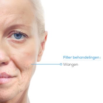 Wangen opvullen SkinFix Schoonheidssalon Schoonheidsspecialiste Volkel Uden Veghel Oss Erp Boekel Mill Nistelrode Vorstenbosch Wangen opvullen in Volkel Uden