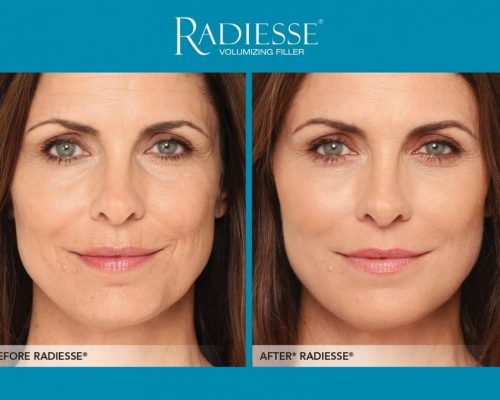 Cosmetisch arts NVCG KNMG Medisch Schoonheidsspecialiste Cosmetisch arts PH Formula Skin Resurfacing Permanente make up Cosmetisch arts Huidtherapie SkinFix Schoonheidssalon Schoonheidsspecialiste Volkel Uden Veghel Oss Erp Boekel Mill Nistelrode Vorstenbosch Fillers