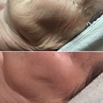 Derma pen Fusion Microneedling Medisch Schoonheidsspecialiste Cosmetisch arts PH Formula Skin Resurfacing Permanente make up Cosmetisch arts Huidtherapie SkinFix Schoonheidssalon Schoonheidsspecialiste Volkel Uden Veghel Oss Erp Boekel Mill Nistelrode Vorstenbosch Derma pen Fusion