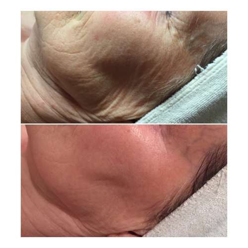 Microneedling Medisch Schoonheidsspecialiste Cosmetisch arts PH Formula Skin Resurfacing Permanente make up Cosmetisch arts Huidtherapie SkinFix Schoonheidssalon Schoonheidsspecialiste Volkel Uden Veghel Oss Erp Boekel Mill Nistelrode Vorstenbosch Microneedling