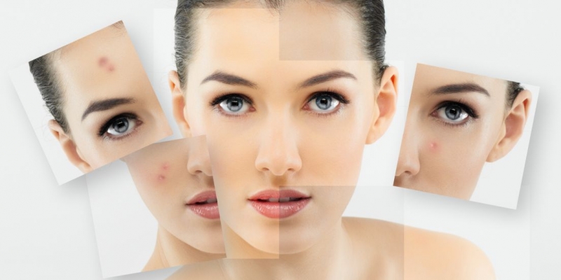 ACNE SkinFix Schoonheidssalon Schoonheidsspecialiste Volkel Uden Veghel Oss Erp Boekel Mill Acne